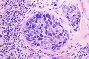 Machine learning technique helps distinguish between healthy and cancerous tissue